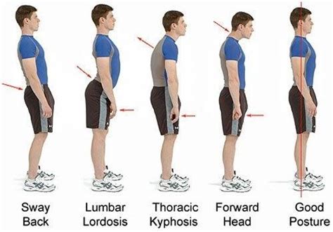 Can Chiropractor Improve Poor Posture