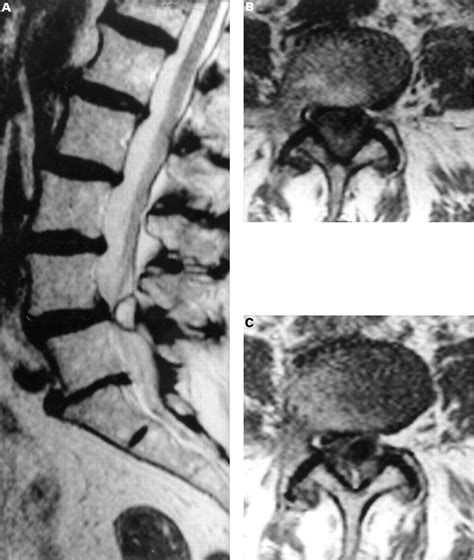 Diagnosis And Surgical Management Of Intraspinal Synovial Cysts Report