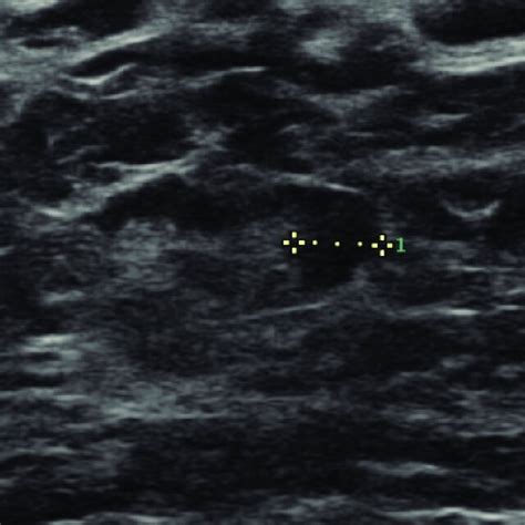 Ultrasound Of An Axillary Lymph Node With Diffuse Cortex Thickening And