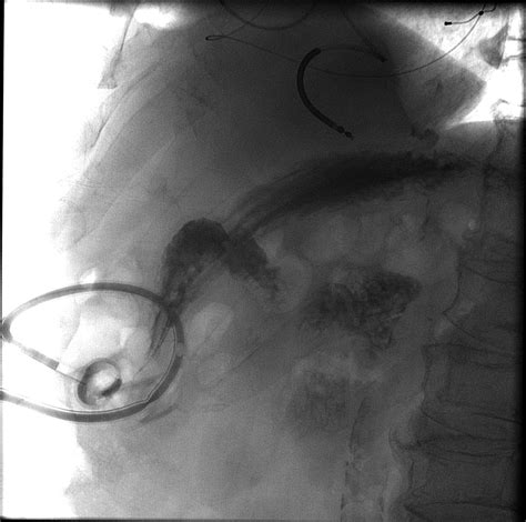 Buried Bumper Syndrome Gastrostomy Tube Image