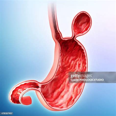 Hiatal Hernia Photos And Premium High Res Pictures Getty Images