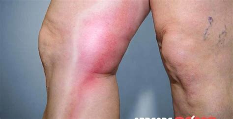 Causas de una trombosis linear unit solfa syllable pierna. Qué es la flebitis y como se cura? Sintomas - 2020
