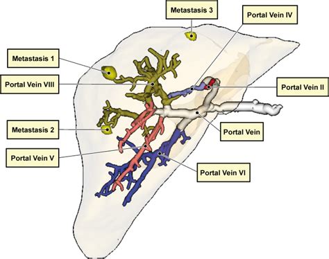 A Labeling Of The Portal Vein And Metastases Located Inside The