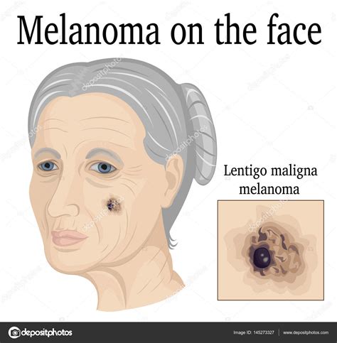Lentigo Melanoma Maligno Pathology Outlines Lentigo Maligna Melanoma