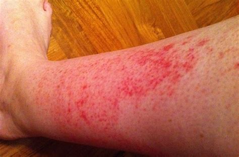 Rash On Arms And Legs Itchy Red Causes Small Bumps Pictures Not