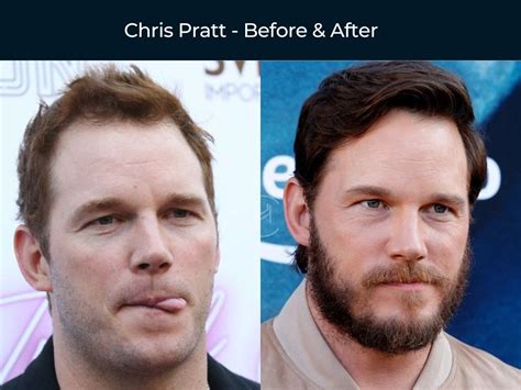 56 Celebrity Hair Transplants Before And After Photos 2023