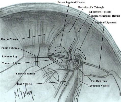 Open Inguinal Hernia Repair Anatomy Anatomy Structure
