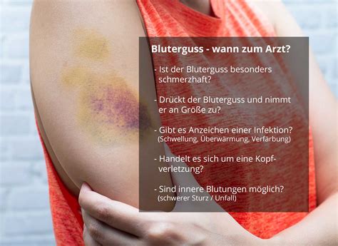 Ich bin gestern stark umgeknickt ist direkt angeschwollen und starke schmerzen, konnte noch ganz ok laufen. Wann sollte man mit einem Bluterguss zum Arzt?