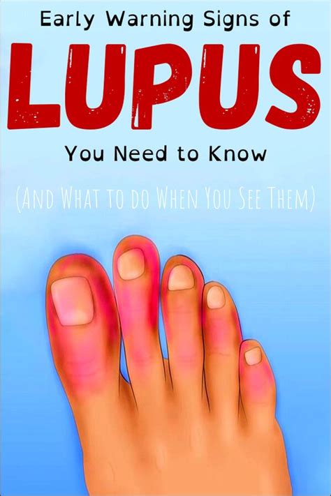 Health And Tips Early Warning Signs Of Lupus You Need To Know And