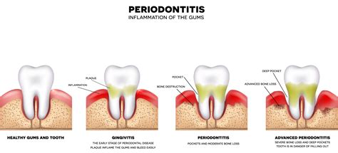 What Is Gum Disease The California Society Of Periodontists