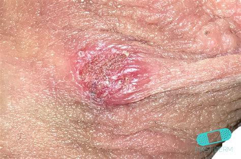 Because we're hsv and we can. Online Dermatology - Genital Herpes
