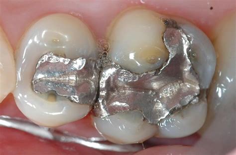 What Is A Dental Amalgam Canyon Gate Dental Of Orem