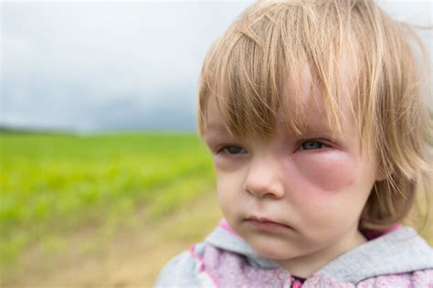 Аллергия на лице что делать и как лечить