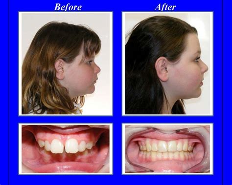 I have overbite with a gap like that, although in my case it's just the front teeth that stick out instead of the whole lower jaw being set back. This patient's overbite was more than 4 times the normal ...