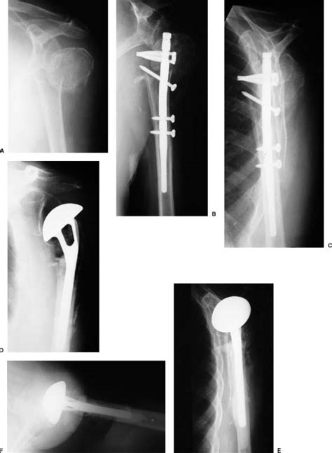 Complications Of Proximal Humeral Fractures Musculoskeletal Key