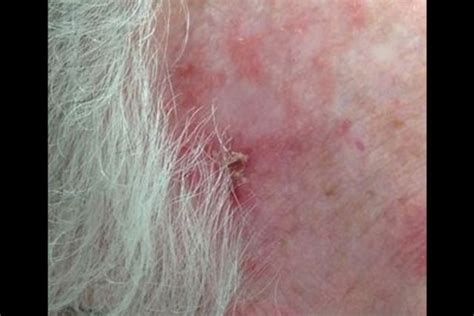 Derm Dx Lesion On The Temple Clinical Advisor