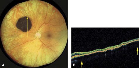 Photoreceptor Loss Overlying Congenital Hypertrophy Of The Retinal