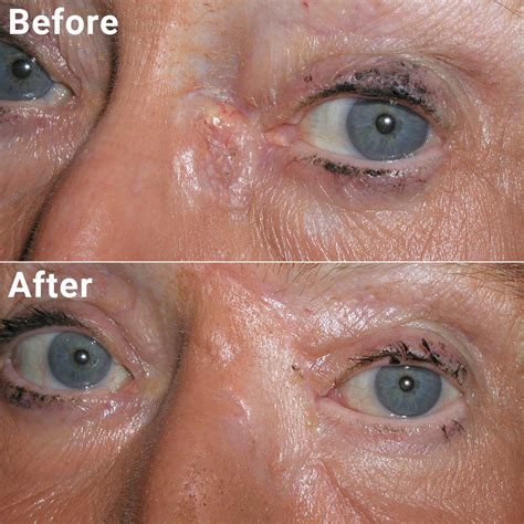 Eyelid Skin Cancer Photos