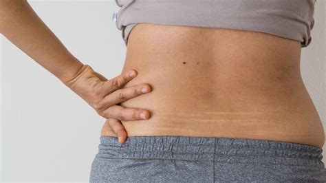 Methods To Minimize The Appearance Of Stretch Marks