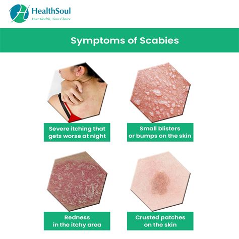 scabies symptoms diagnosis prevention and treatment of scabies images