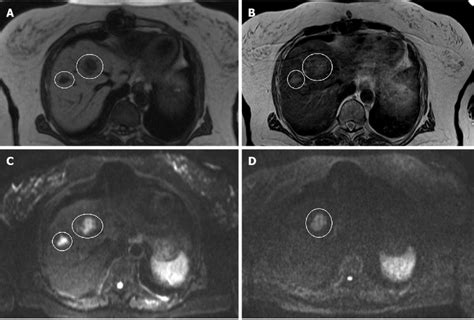 Mri And Dwi Of Hepatic Metastases A T1 Weighted B T2 Weighted C