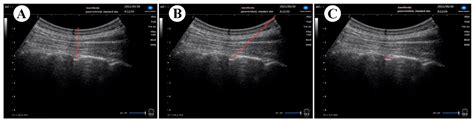 Jcm Free Full Text Real Time Ultrasound Guided Thoracic Epidural