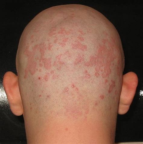 Does Seborrheic Dermatitis Cause Hair Loss