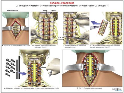 4 Level C3 C7 Cervical Spine Decompression Surgical Procedure