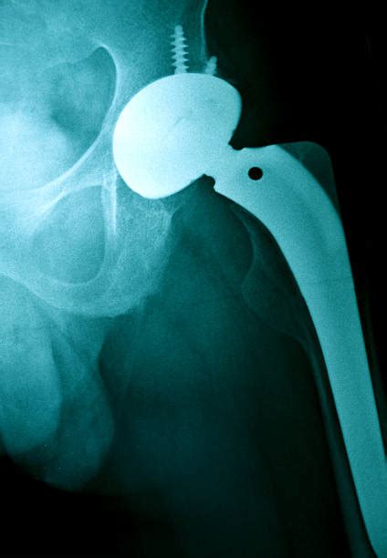 Hip Replacement Surgery Stock Photos Pictures And Royalty Free Images