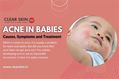 Acne In Babies Causes Symptoms And Treatment