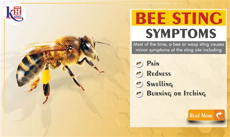 Bee Sting Allergy Symptoms Of Anaphylaxis Kailash Health Blog