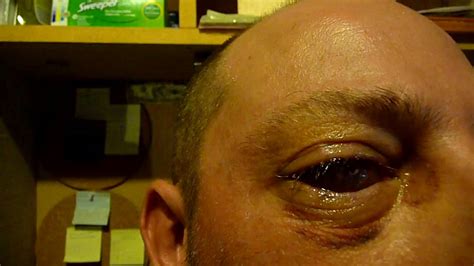 Check spelling or type a new query. 9 Days after my Eye Removal Surgery - YouTube