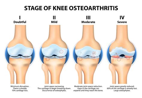 What Is Osteoarthritis OA Of The Knee Complete Physio