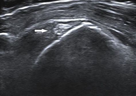 Ultrasound Guided Percutaneous Treatment For Calcific Tendinitis Of The