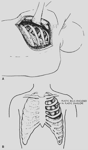 Thoracoplasty Indications And Surgical Considerations Thoracic Key