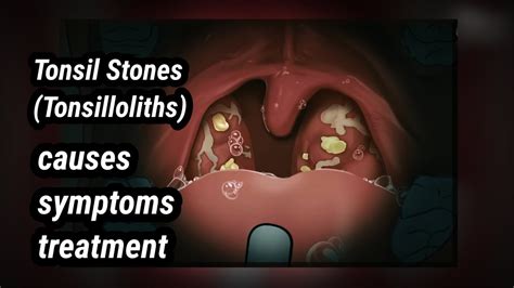 Tonsil Stones Tonsilloliths Youtube