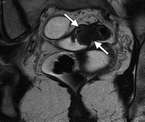 Mr Imaging In Deep Pelvic Endometriosis A Pictorial Essay Radiographics