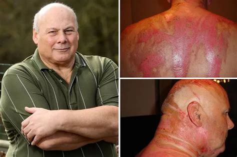 Pensioner Horrifically Scarred After Wife Poured Boiling Water Over Him Says Theres No Shame