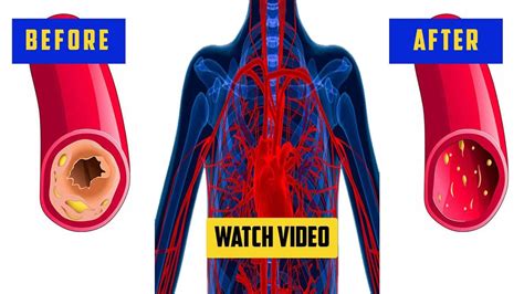 How To Clean Blood Vessels And Clogged Arteries Naturally Remove