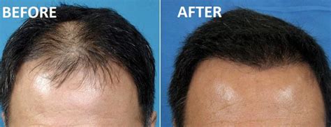 What Is A Stem Cell Hair Transplant How Does It Help With Your Hair Regrowth Techduffer