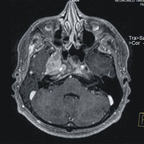 Cranial Mri With Contrast Enhancementright Internal Carotid Artery