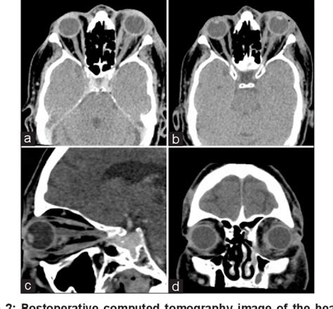 Figure 2 From A Rare Case Of Isolated Intracranial Rosaidorfman