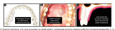 Figure From Year Journey Of Palatal Connective Tissue Graft