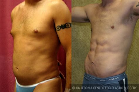 Patient Male Liposuction Abdomen Before And After Photos Encino Plastic Surgery Gallery