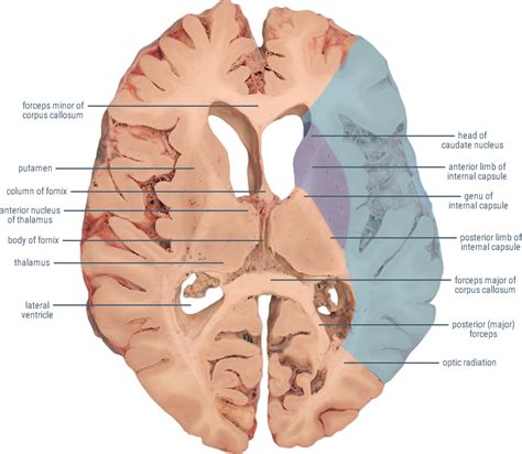 A hemorrhagic stroke is a brain hemorrhage resulting from a weakened blood vessel that breaks and bleeds into the surrounding brain tissue. Middle Cerebral Artery