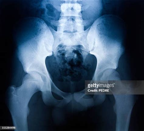 Pelvis X Ray Photos And Premium High Res Pictures Getty Images