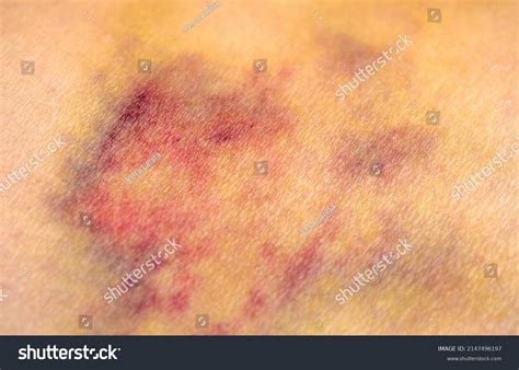 Bruises On Human Body Severe Bruise Foto Stock 2147496197 Shutterstock