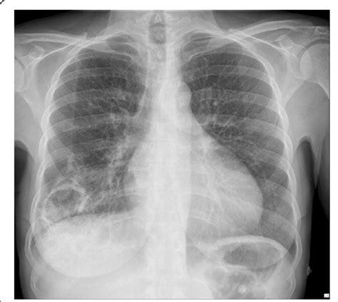 Chest X Ray Showing A Community Acquired Pneumonia Due To A Pittii