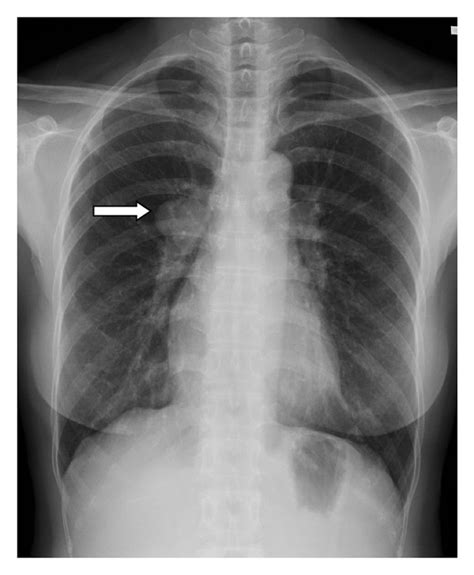 A Chest X Ray Study Detects A Mass White Arrow In The Right
