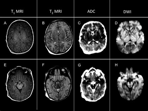 Mri Findings In Infants With Infantile Spasms After Neonatal Hypoxic
